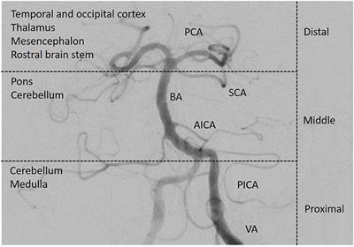 Pitfalls in the Diagnosis of Posterior Circulation Stroke in the Emergency Setting